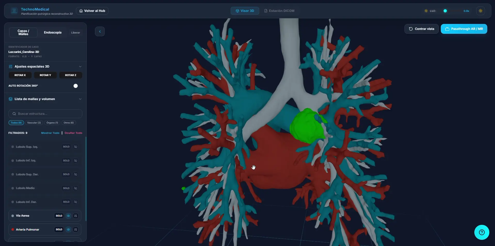 Acercamiento a la anatomía broncovascular y los nódulos representados en verde