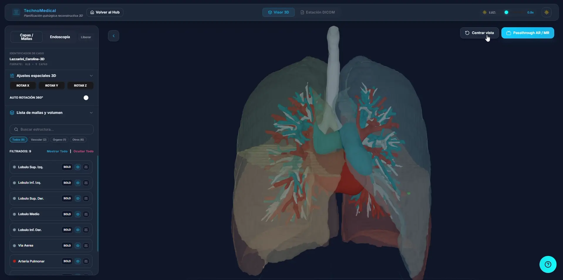 Vista tridimensional conjunta de pulmones y estructuras broncovasculares